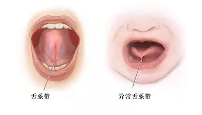 舌头探洞水好多怎么办？舌头探洞原因、处理方法及预防措施解析与建议